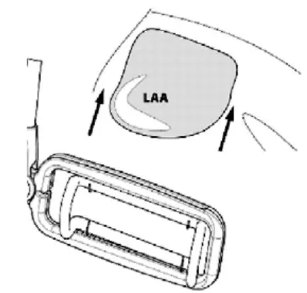 AtriCure ACH135 AtriClip LAA Exclusion System - Orient the Clip applier with pre-loaded Clip at the tip of LAA with the loops