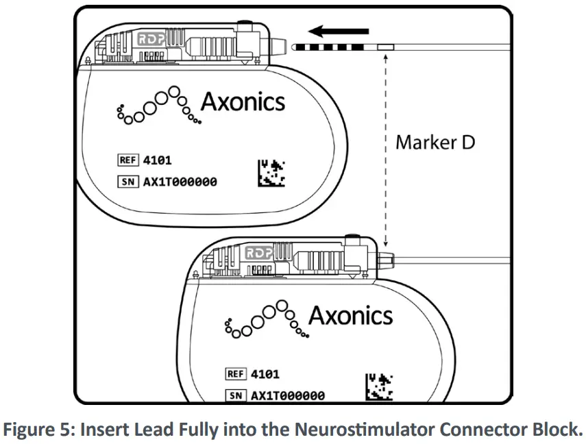 Axonics F15 Neurostimulator - Neurostimulator 2
