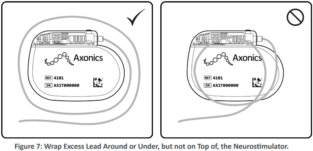 Axonics F15 Neurostimulator - Neurostimulator 4