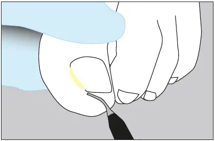 unguisan-BLUELIGHT-KOMPLETT-SET-Light-Starter-Set-FIG-8