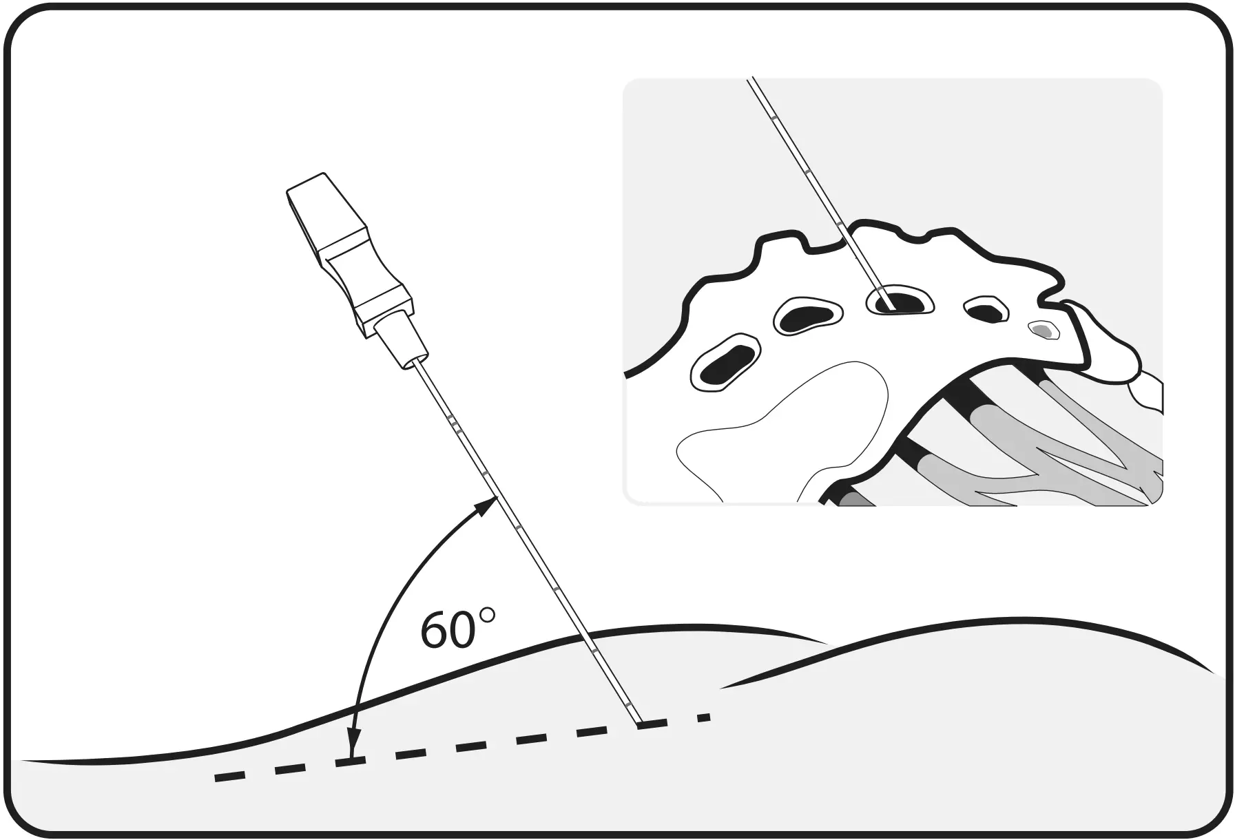 Insert the foramen needle