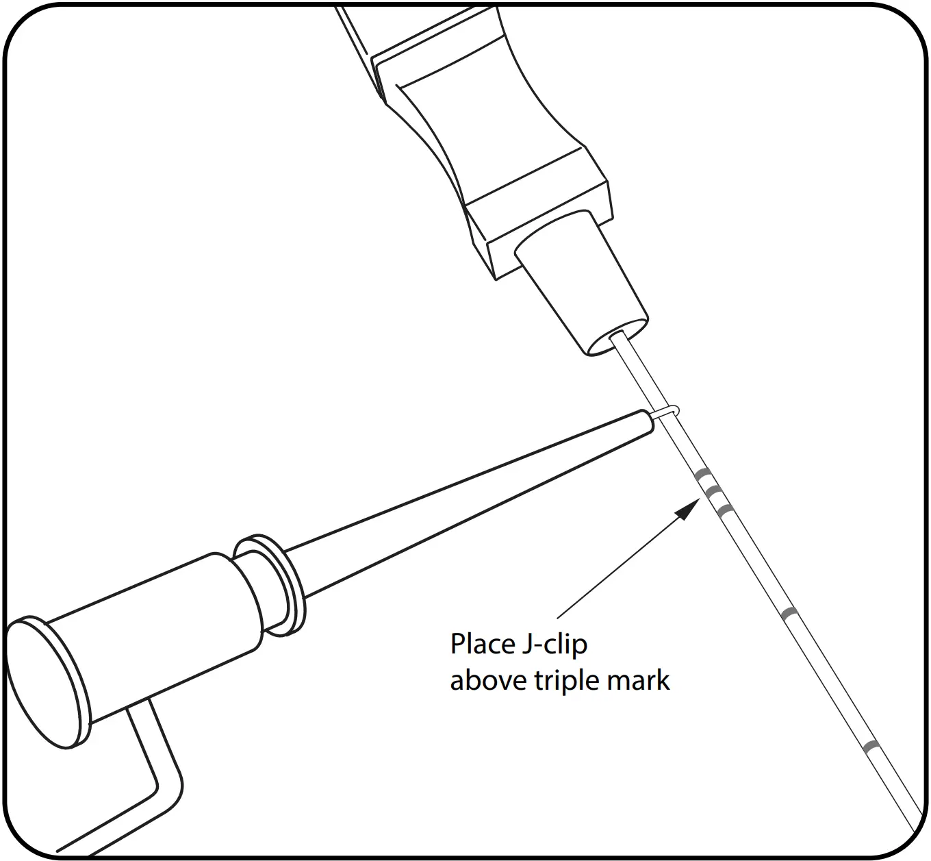 Insert the foramen needle