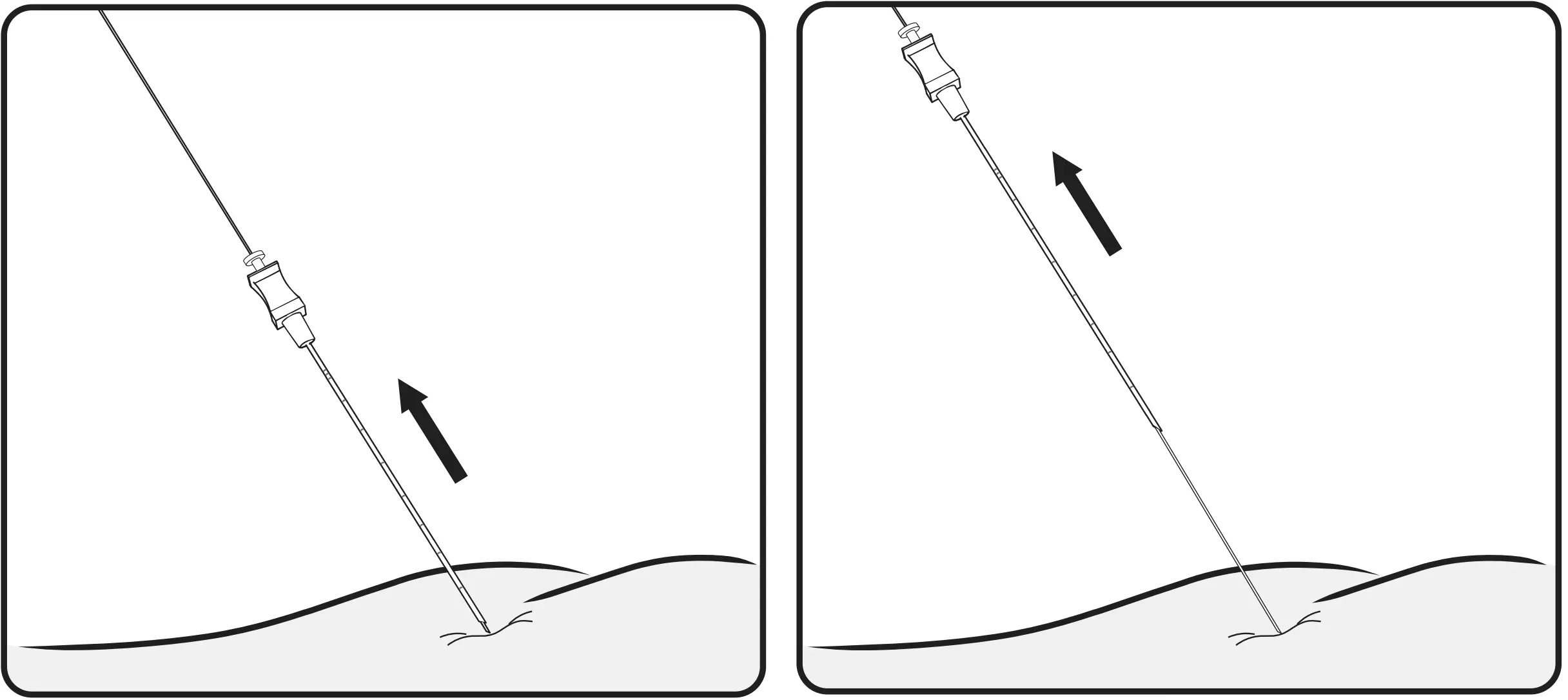 Remove the foramen needle