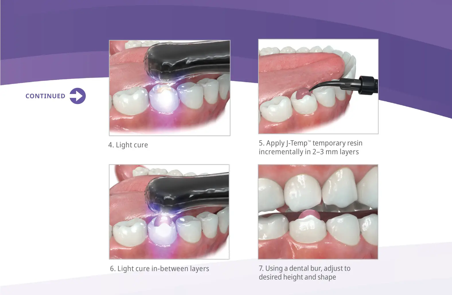 Ultradent J-Temp Temporary Resin - BITE RAMPS AND TEMPORARY OCCLUSAL BUILD UPS DURING ORTHODONTICS 2