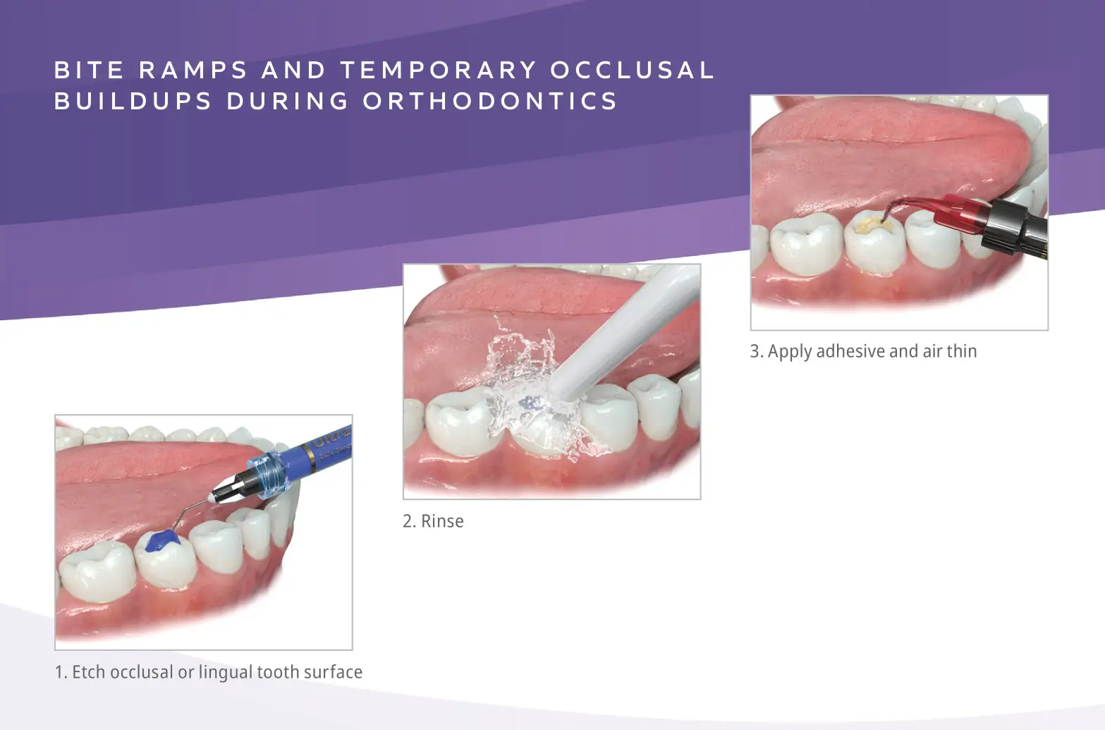 Ultradent J-Temp Temporary Resin - BITE RAMPS AND TEMPORARY OCCLUSAL BUILD UPS DURING ORTHODONTICS