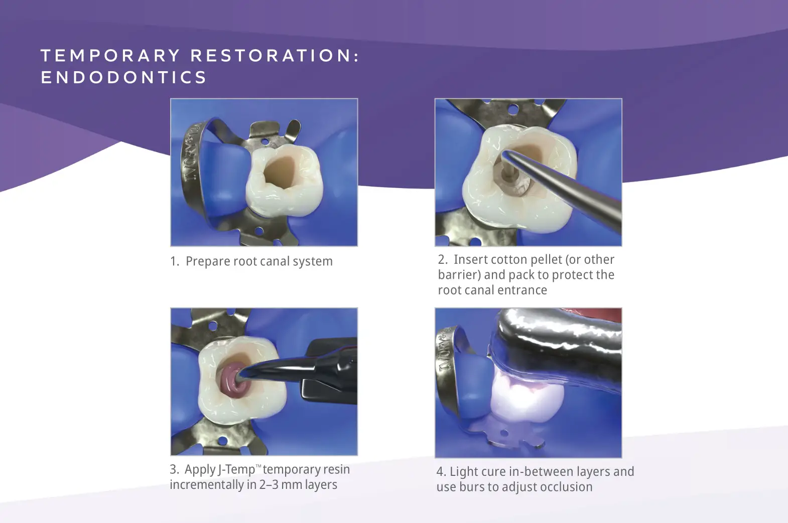 Ultradent J-Temp Temporary Resin - ENDODONTICS