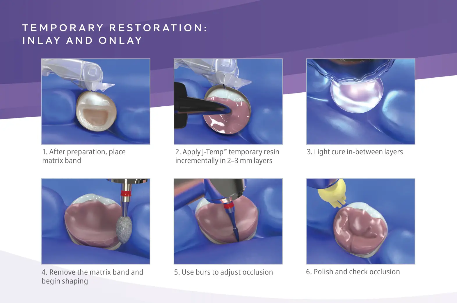 Ultradent J-Temp Temporary Resin - INLAY AND ONLAY