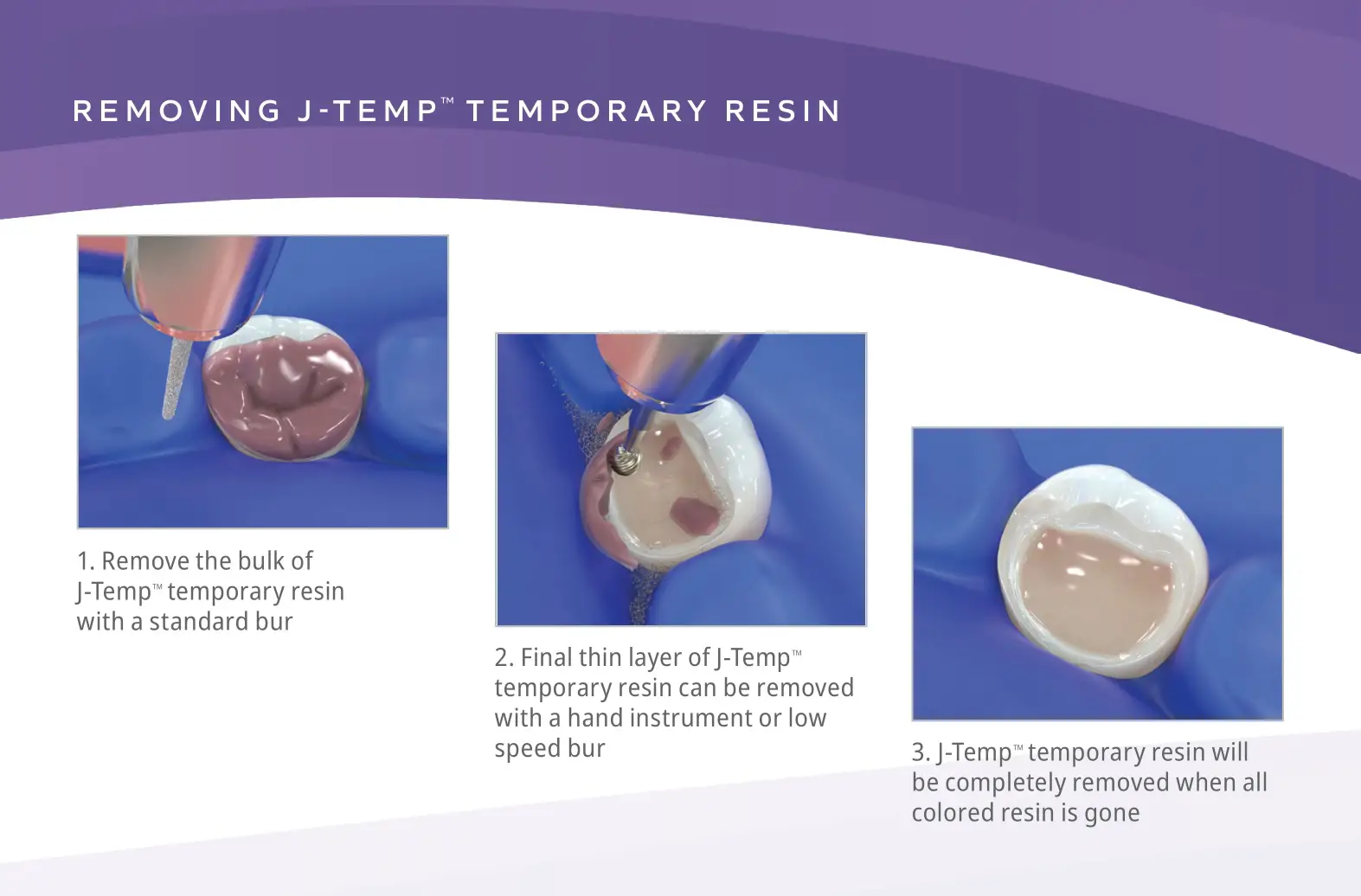 Ultradent J-Temp Temporary Resin - REMOVINGJ -TEMP