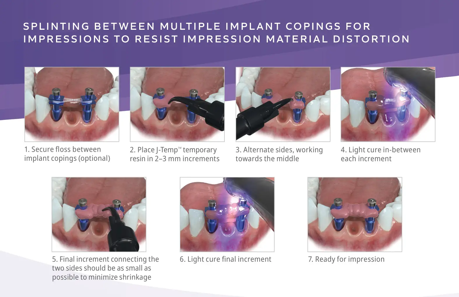Ultradent J-Temp Temporary Resin - SPLINTING BETWEEN MULTIPLE IMPLANT COPINGS FOR IMPRESSIONS TO RESIST IMPRESSION MATERIAL DISTORTION