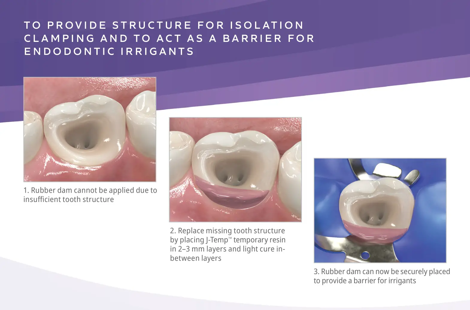 Ultradent J-Temp Temporary Resin - TO PROVIDE STRUCTURE FOR ISOLATION CLAMPING AND TO ACT AS A BARRIER FOR ENDODONTIC IRRIGANTS