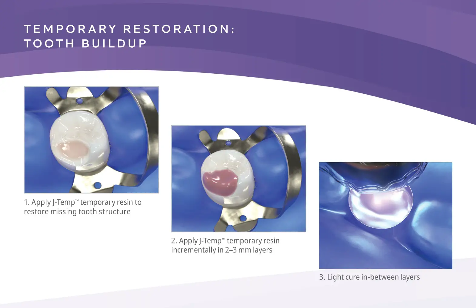 Ultradent J-Temp Temporary Resin - TOOTH BUILD UP