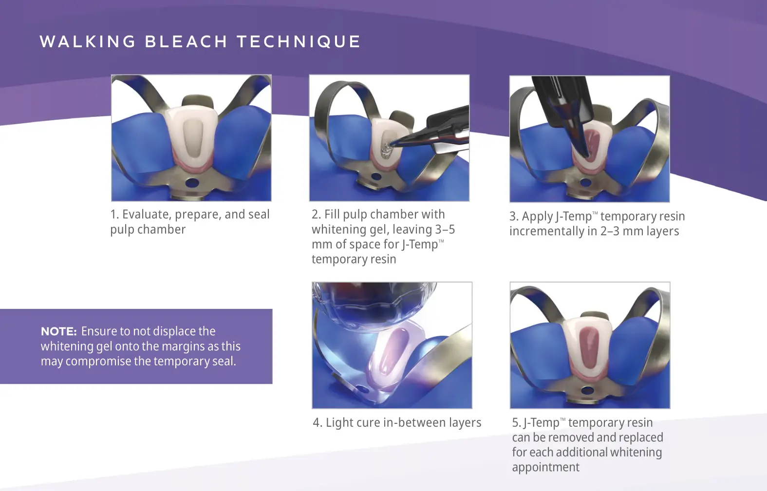 Ultradent J-Temp Temporary Resin - WALKING BLEACH TECHNIQUE