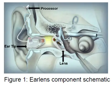 earlens-IFU00037vO-Contact-Hearing-Solution-FIG-1