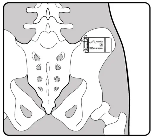 Axonics 5101 Neurostimulator - Fig 3