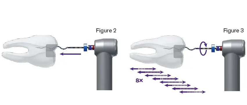 BRASSELER-USA-XP-3D-D-Shaper-and-Finisher-Endo-Files-fig-5