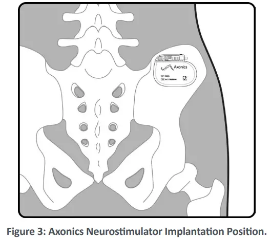 Axonics 4101 Neurostimulator - DEVICE 2