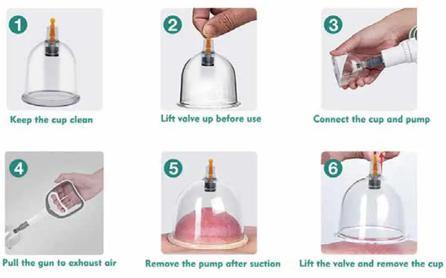 SURMOL-B0C2V2VZMV-Professional-Cupping-Set-FIG- (1)