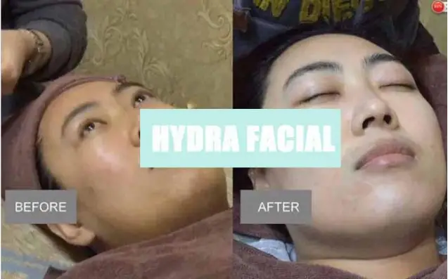 REJUVA FRESH SR-AF1317A 8 in 1 Hydra Facial Machine - c45