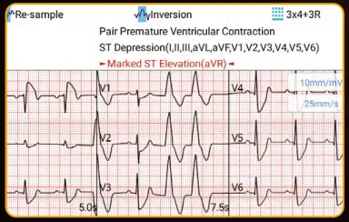 EDAN-SE-1200-Pro-Express-Basic-ECG-Machine-fig- (2)