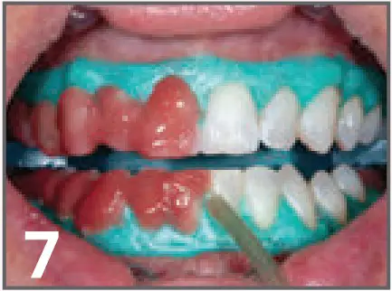 ULTRADENT Opalescence Boost PF 40% In Office Power Whitener - fig 11