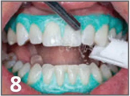 ULTRADENT Opalescence Boost PF 40% In Office Power Whitener - fig 12