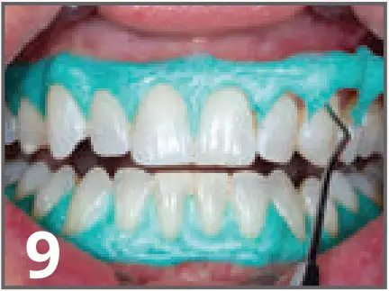 ULTRADENT Opalescence Boost PF 40% In Office Power Whitener - fig 13