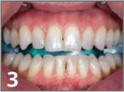 ULTRADENT Opalescence Boost PF 40% In Office Power Whitener - fig 7