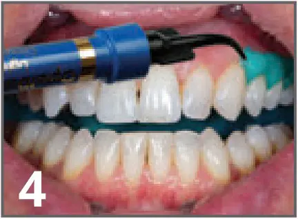 ULTRADENT Opalescence Boost PF 40% In Office Power Whitener - fig 8