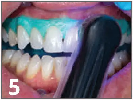 ULTRADENT Opalescence Boost PF 40% In Office Power Whitener - fig 9