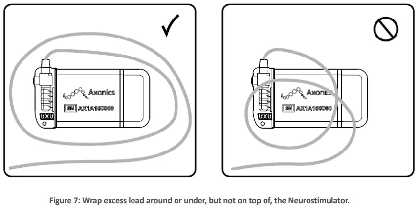 Axonics-1101-Neurostimulator-fig-10