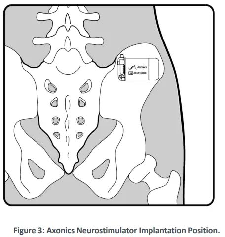 Axonics-1101-Neurostimulator-fig-6