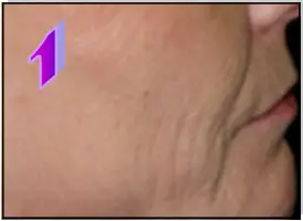 Avance Beauty IPL350 SCR E Light Flux Professional IPL Scar Reduction System - General Dermatology 2