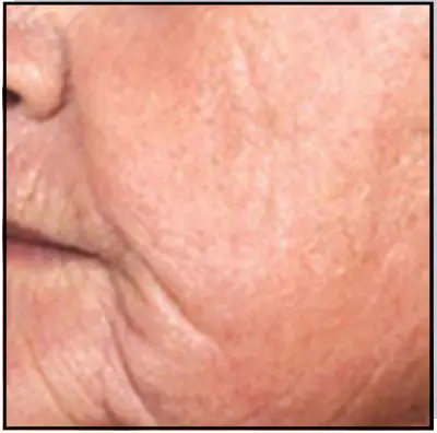 Avance Beauty IPL350 SCR E Light Flux Professional IPL Scar Reduction System - IPL Resurfacing 2