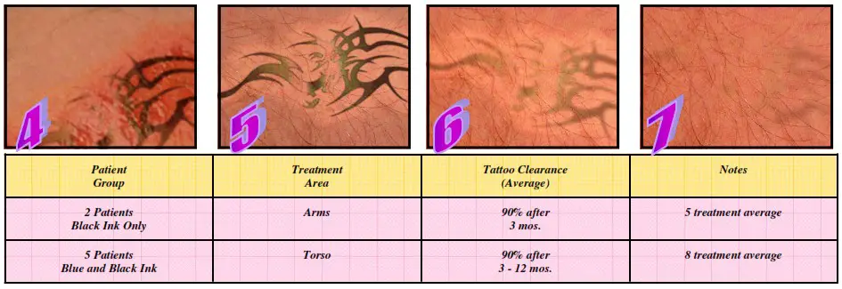 Avance Beauty IPL350 SCR E Light Flux Professional IPL Scar Reduction System - Tattoo Removal 3