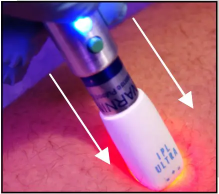 Avance Beauty IPL350 SCR E Light Flux Professional IPL Scar Reduction System - nt 1