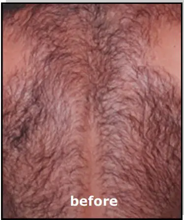 Avance Beauty IPL350 SCR E Light Flux Professional IPL Scar Reduction System - overview 1