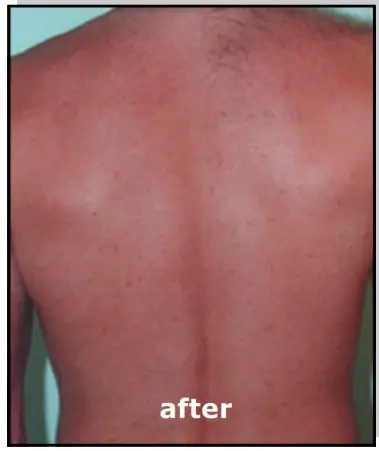 Avance Beauty IPL350 SCR E Light Flux Professional IPL Scar Reduction System - overview 2