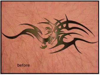 Avance Beauty IPL350 SCR E Light Flux Professional IPL Scar Reduction System - overview 4