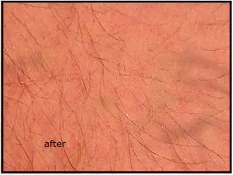 Avance Beauty IPL350 SCR E Light Flux Professional IPL Scar Reduction System - overview 5