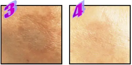 Avance Beauty IPL350 SCR E Light Flux Professional IPL Scar Reduction System - overview 7