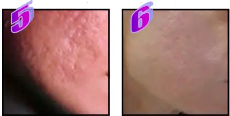 Avance Beauty IPL350 SCR E Light Flux Professional IPL Scar Reduction System - overview 8