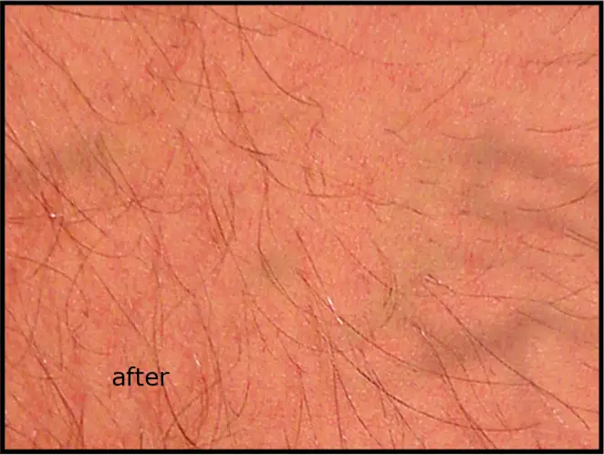 Avance Beauty - After Tattoo Treatment