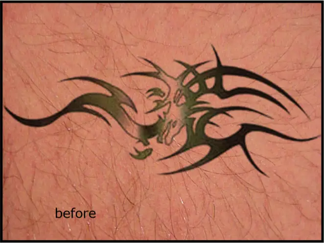 Avance Beauty - Before Tattoo Treatment