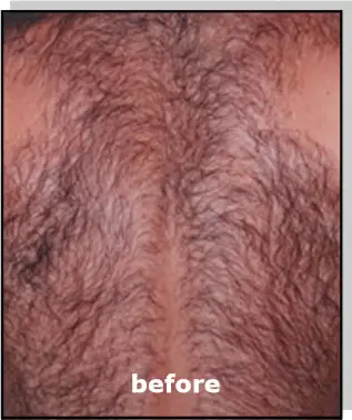 Avance Beauty - Before Treatment