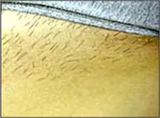 Avance Beauty - IPL Hair Removal Variation 1