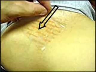 Avance Beauty - IPL Hair Removal Variation 2