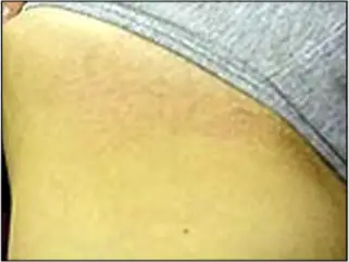 Avance Beauty - IPL Hair Removal Variation 3