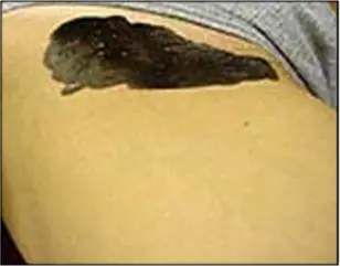 Avance Beauty - IPL Hair Removal Variation 4