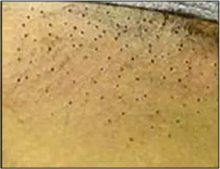 Avance Beauty - IPL Hair Removal Variation 5