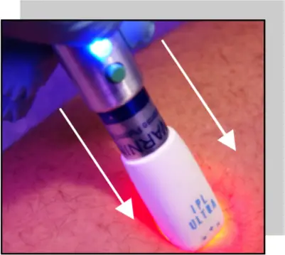 Avance Beauty - IPL Progressively Permanent Hair Removal